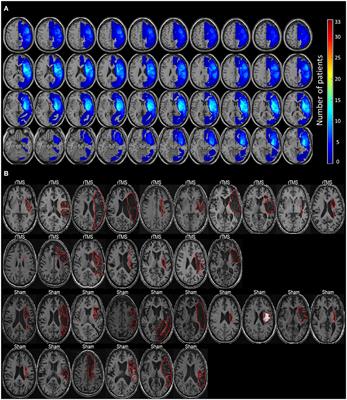 Functional Remodeling Associated With Language Recovery After Repetitive Transcranial Magnetic Stimulation in Chronic Aphasic Stroke